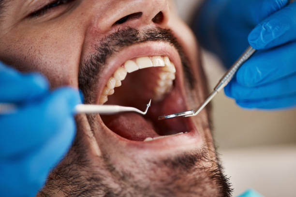 Best Emergency Wisdom Tooth Extraction in Silsbee, TX